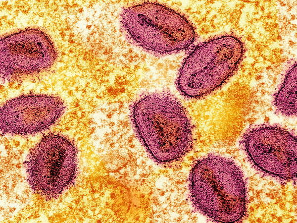 US health officials report 1st case of new form of mpox in a traveler