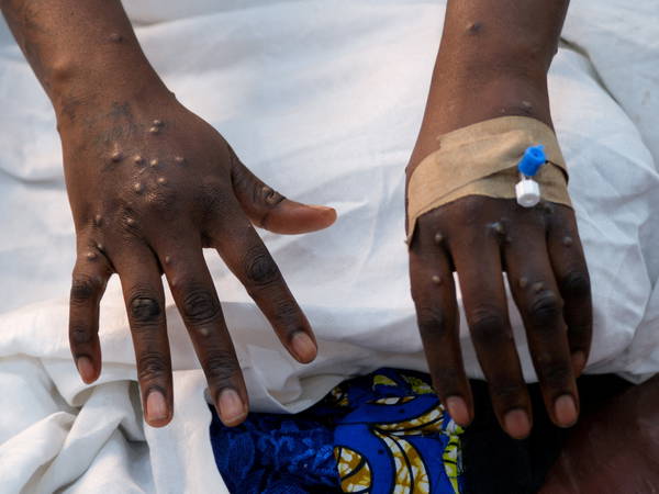 Africa’s mpox deaths surpass 1,000 as health officials urge international support